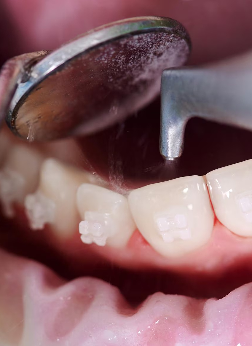 open mouth with professional teeth cleaning using airflow treatment
