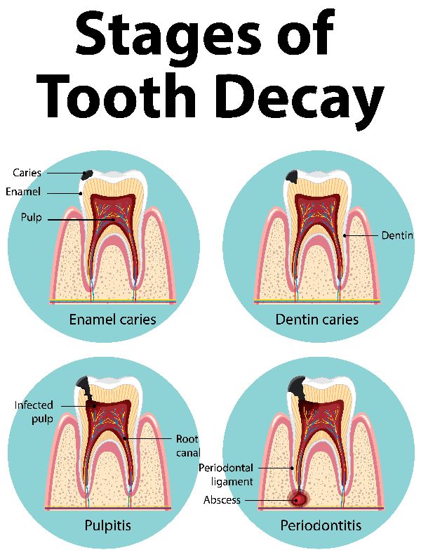 stages of tooth decay