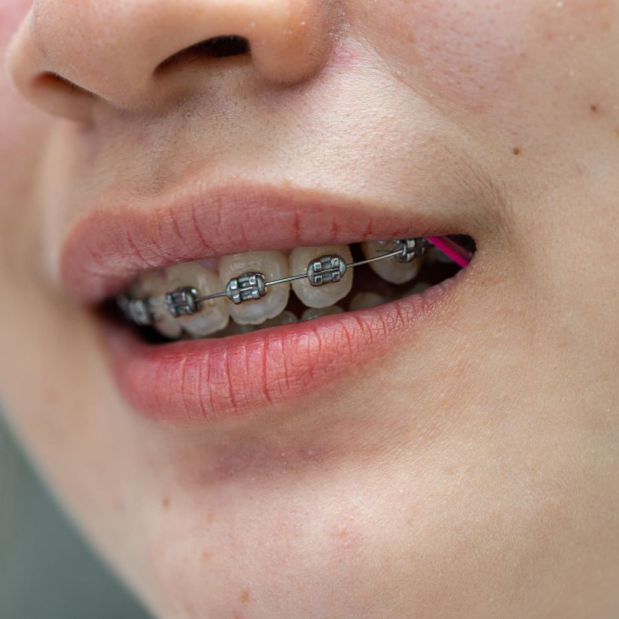 Braces in teenage girl mouth to treat and beauty for increase confidence and good personality